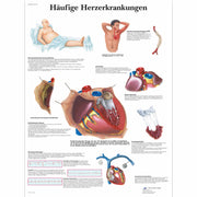 Häufige Herzerkrankungen