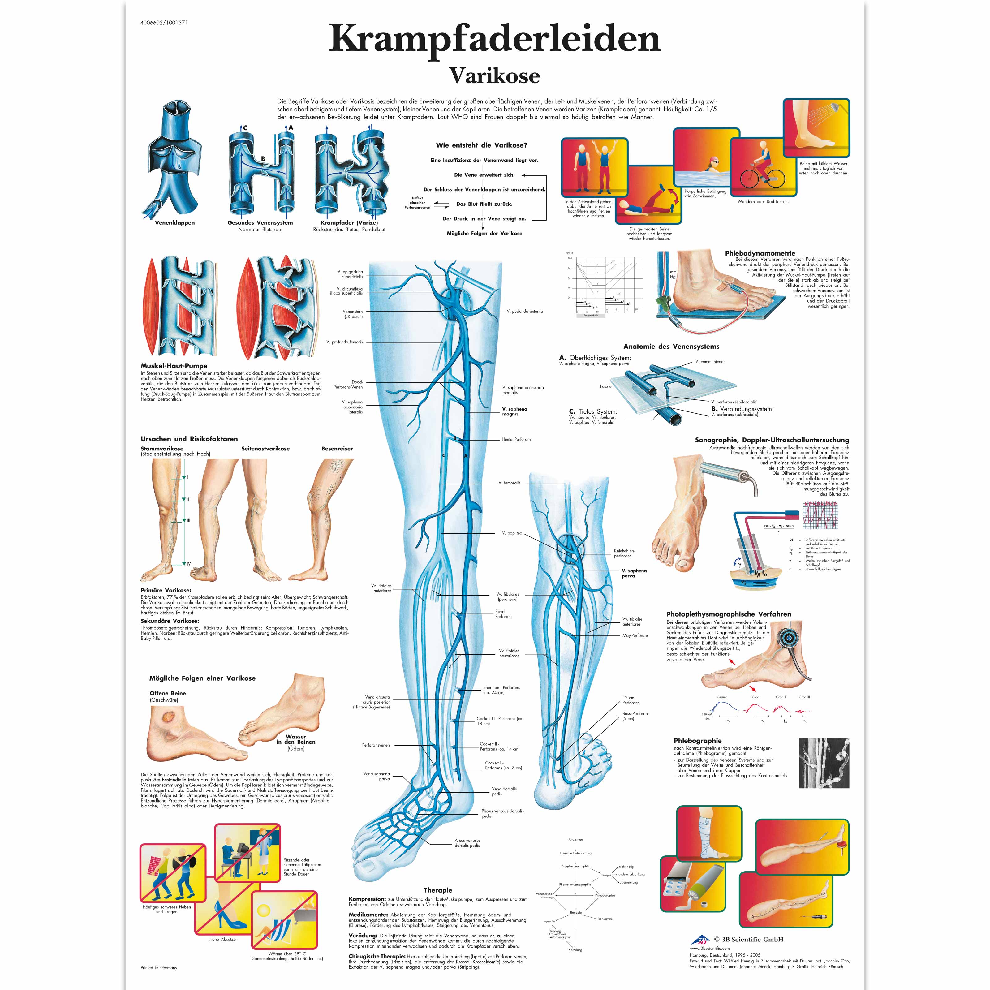 Krampfaderleiden, Varikose
