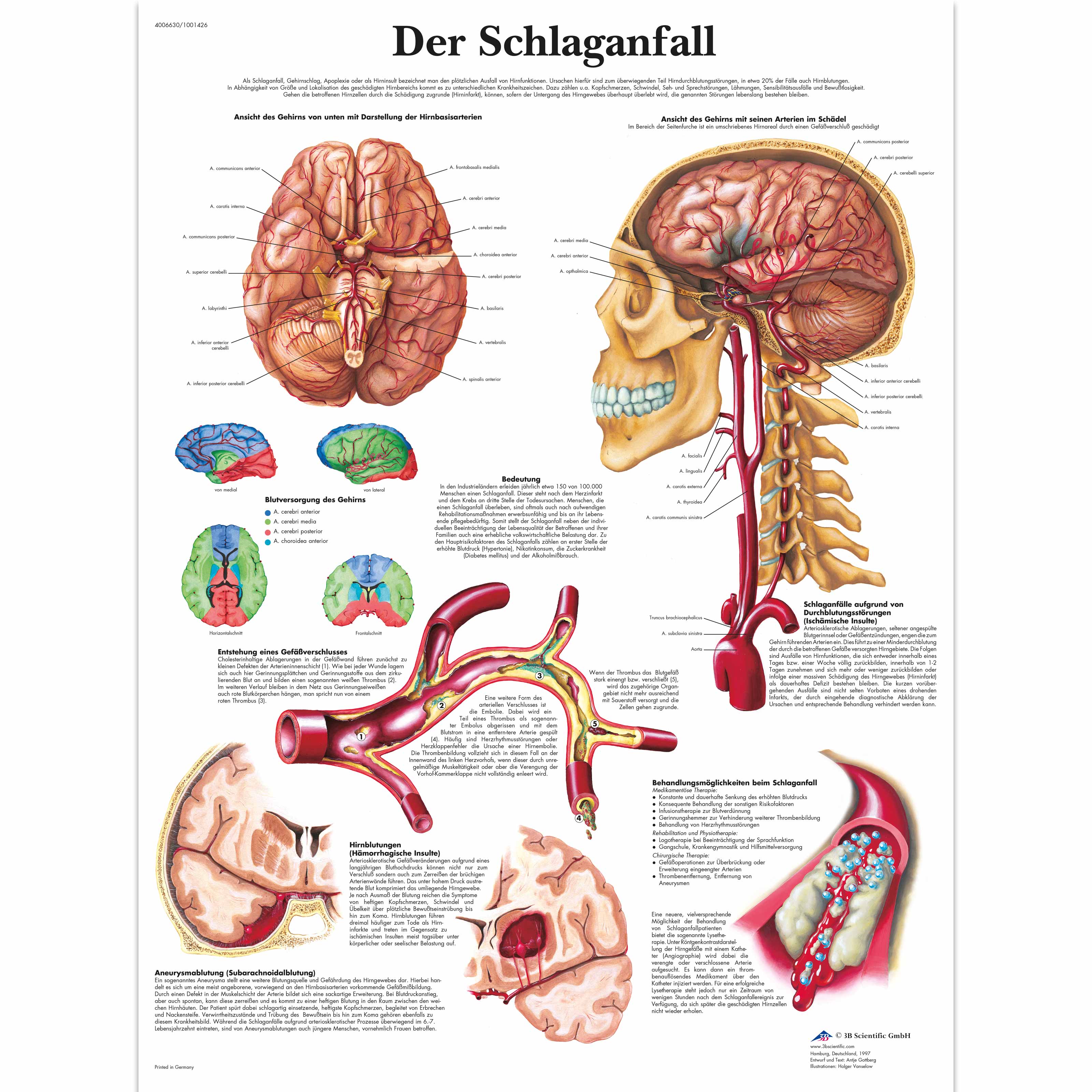 Schlaganfall