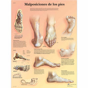 Malposiciones de los pies