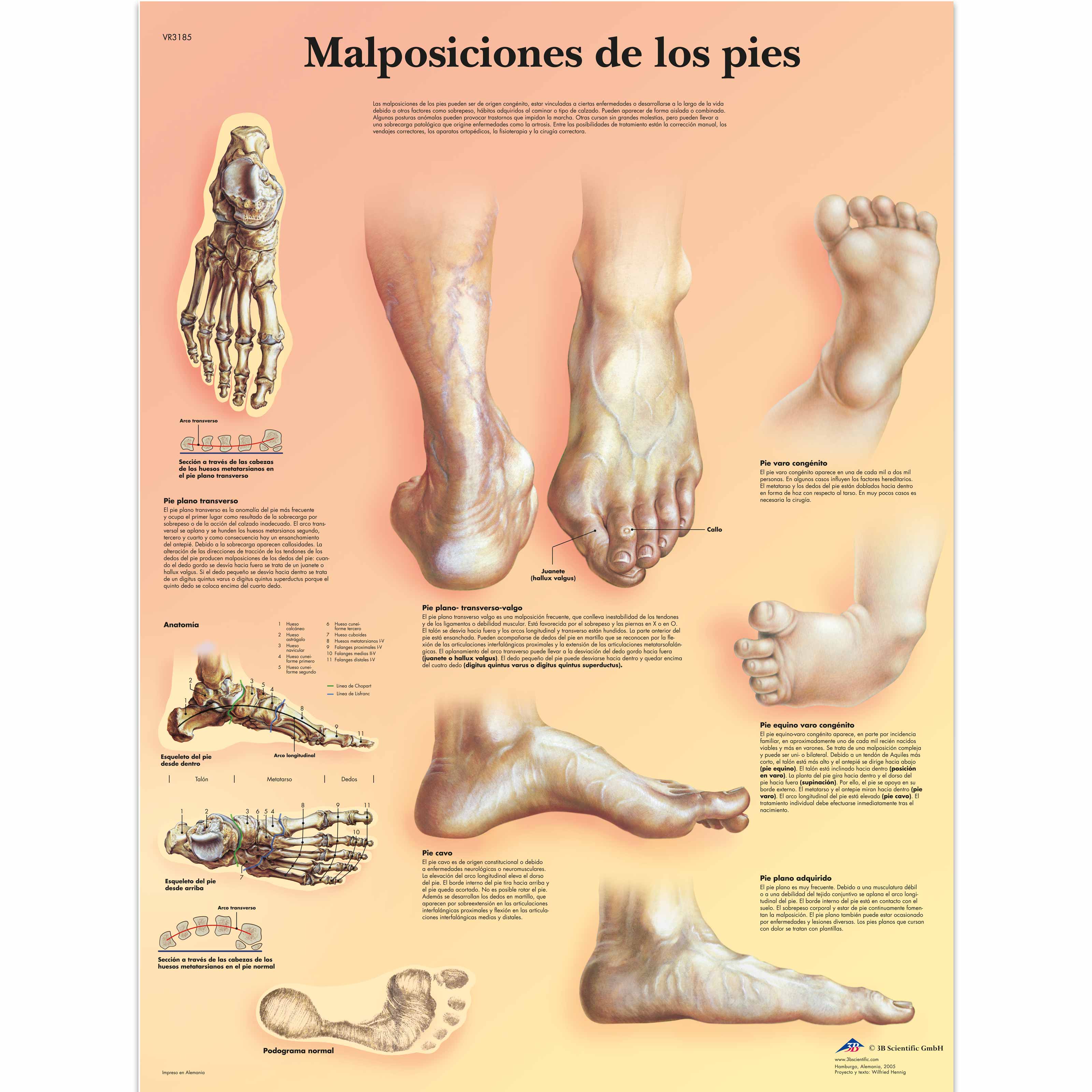 Malposiciones de los pies