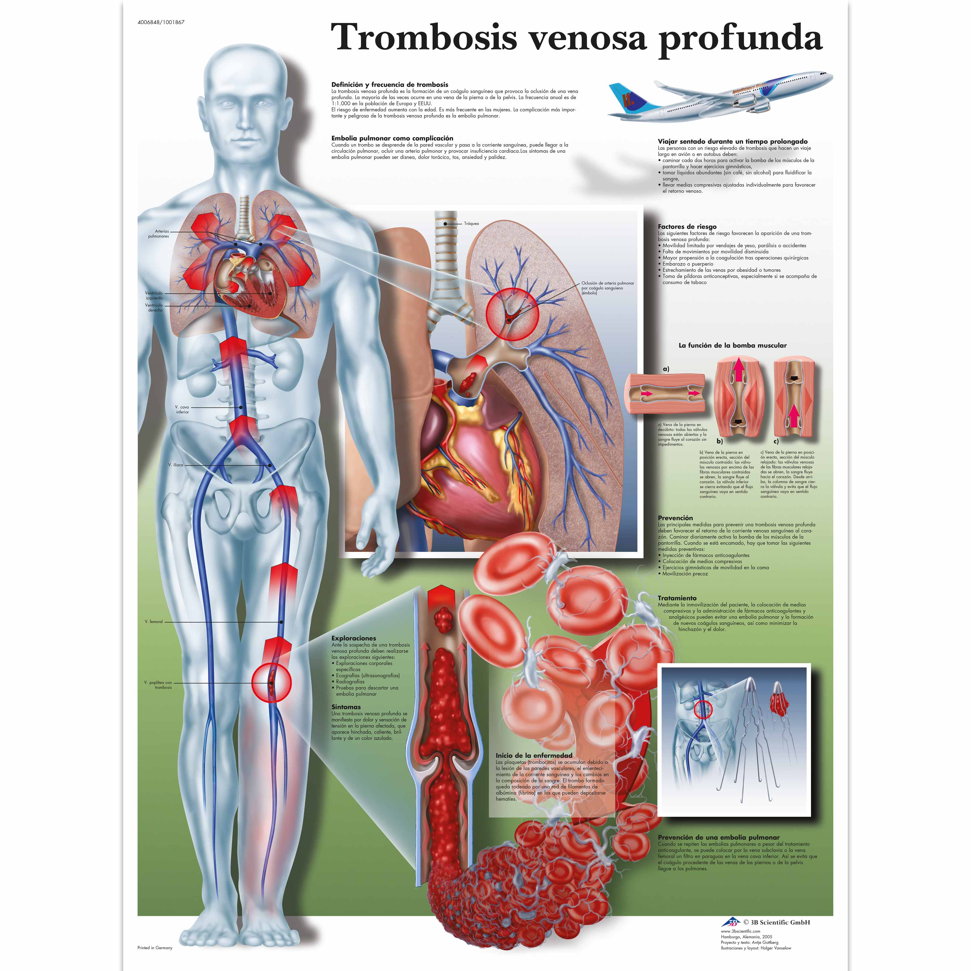 Trombosis venosa profunda