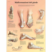 Malformazioni di piede