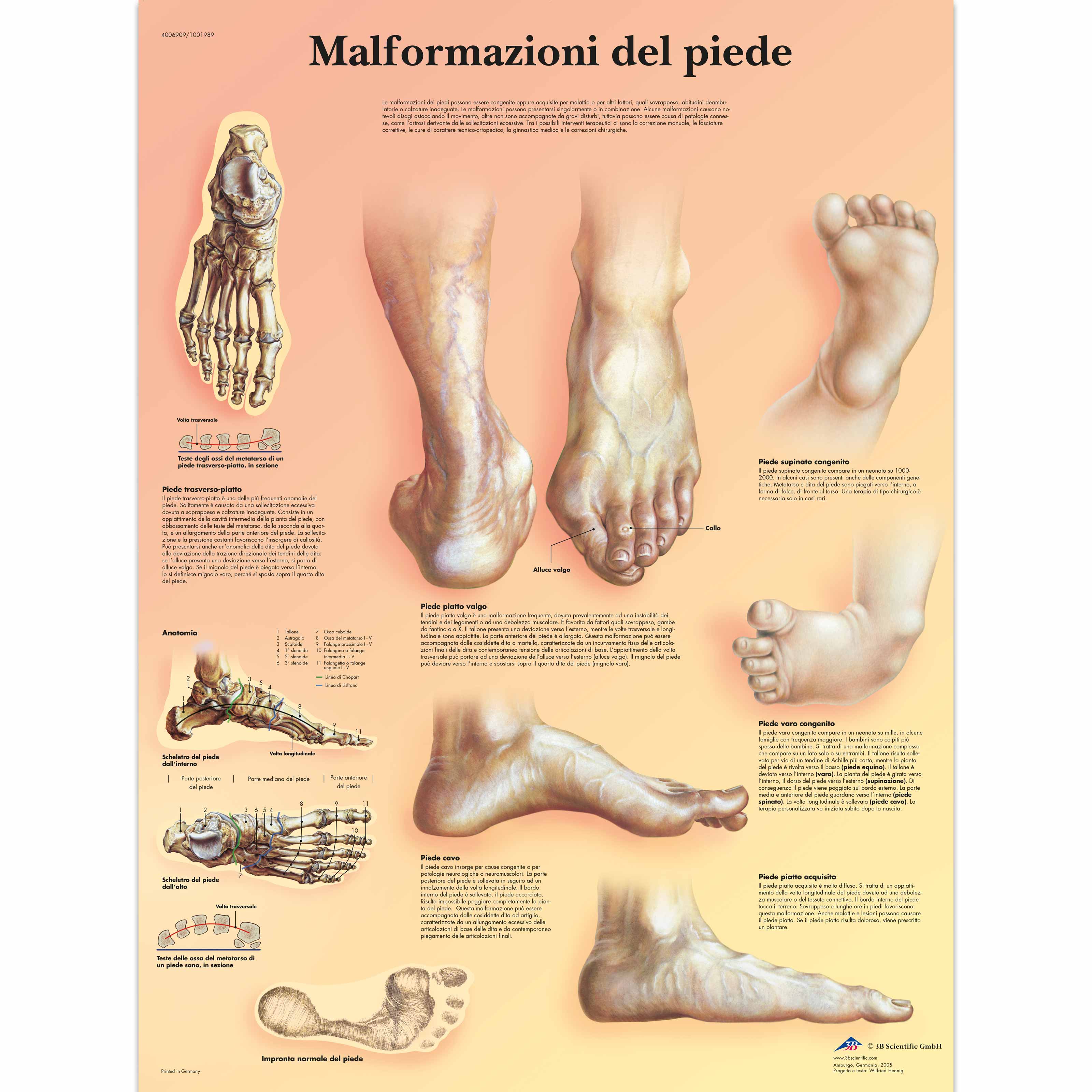 Malformazioni di piede