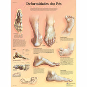Deformidades dos Pés