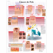 Câncer de Pele