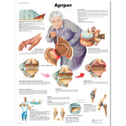 Arthritis Chart