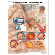 Diseases of the Middle Ear Chart