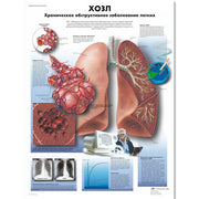 COPD Chart - Chronic Obstructive Pulmonary Disease