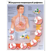 Gastroesophageal reflux disease Chart