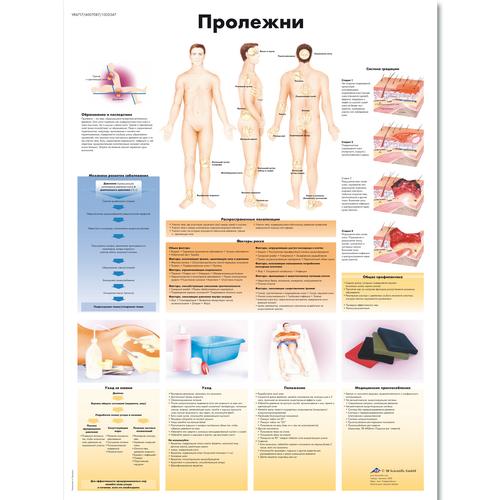 Decubitus Ulcers Chart