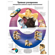 Acceleration Injury to the Cervical Spine Chart