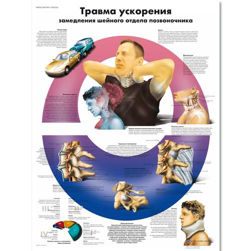 Acceleration Injury to the Cervical Spine Chart