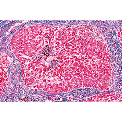 Human Pathology - Spanish