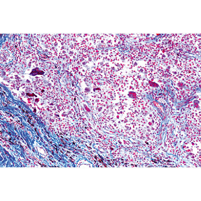Human Pathology - Spanish