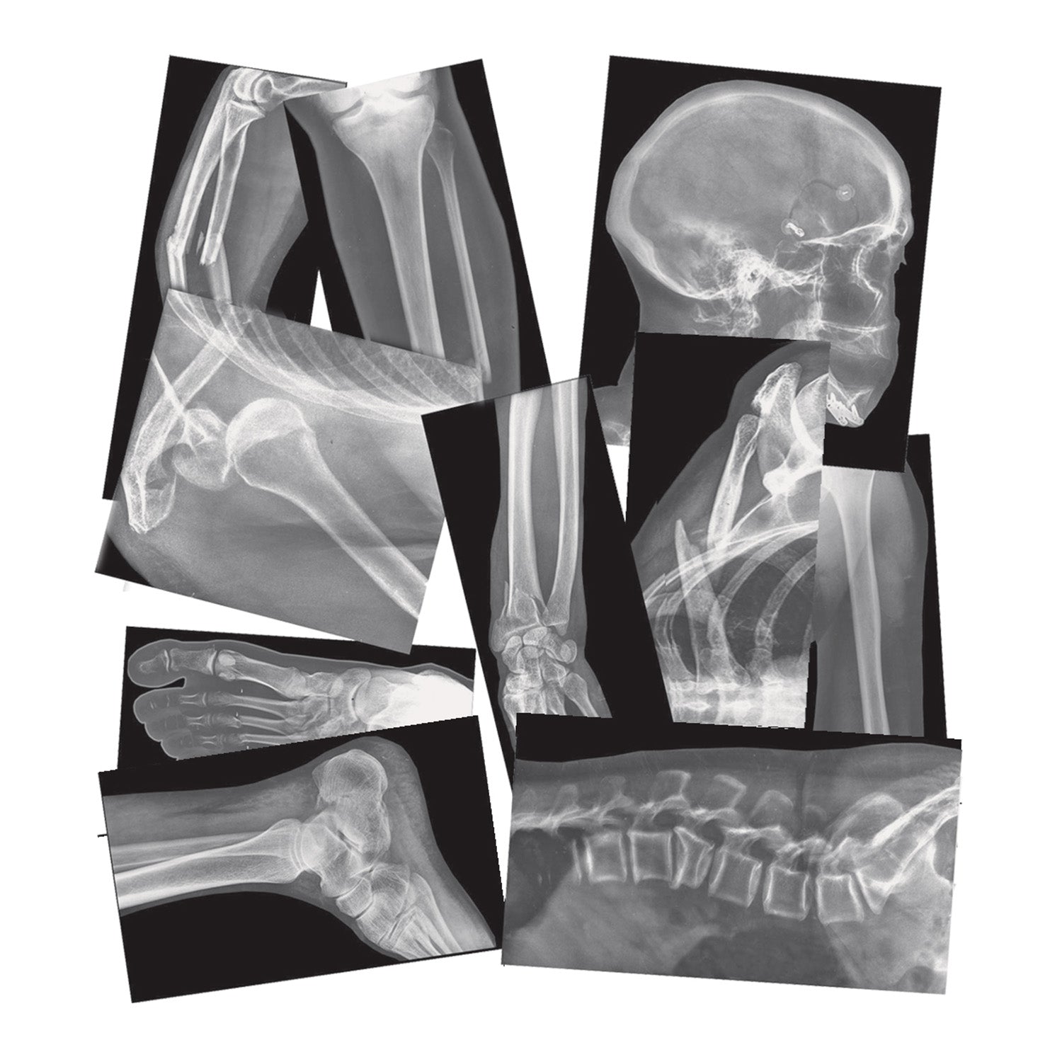 Broken Bones X-Ray Set, Pack of 15