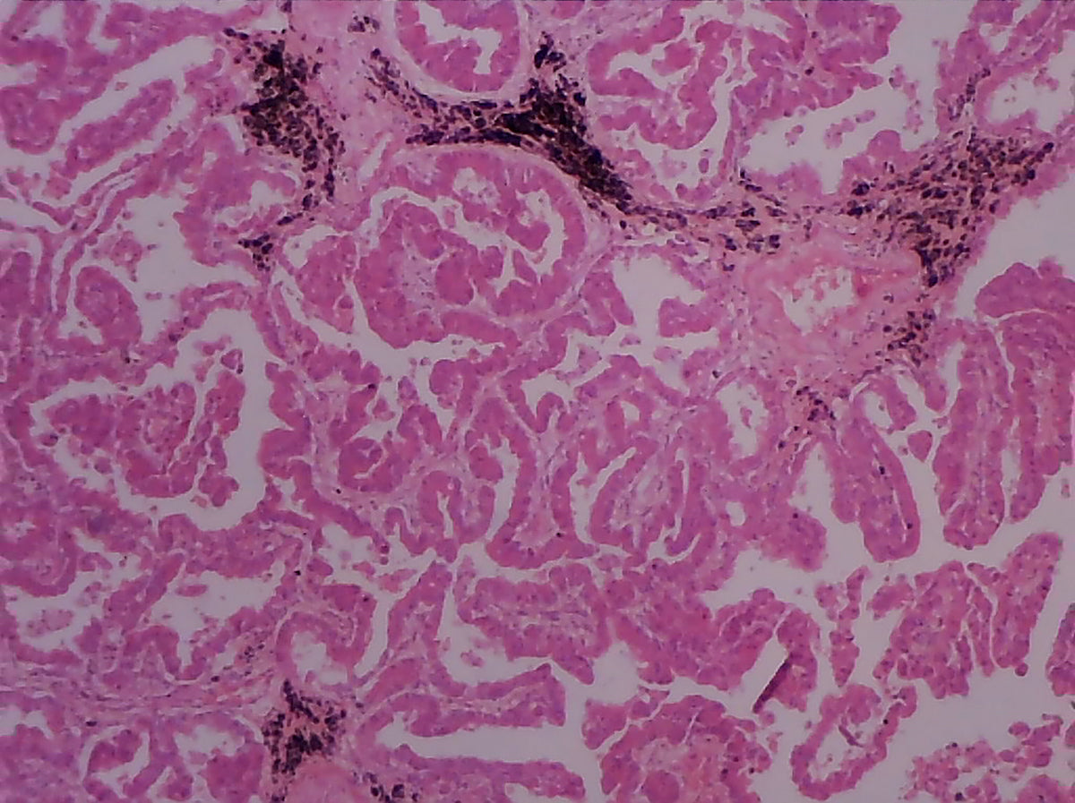 Microscope Slide, Adenocarcinoma of the Lung