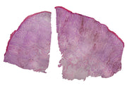 Microscope Slide, Melanoma (Human); Cross Section; H&E Stain