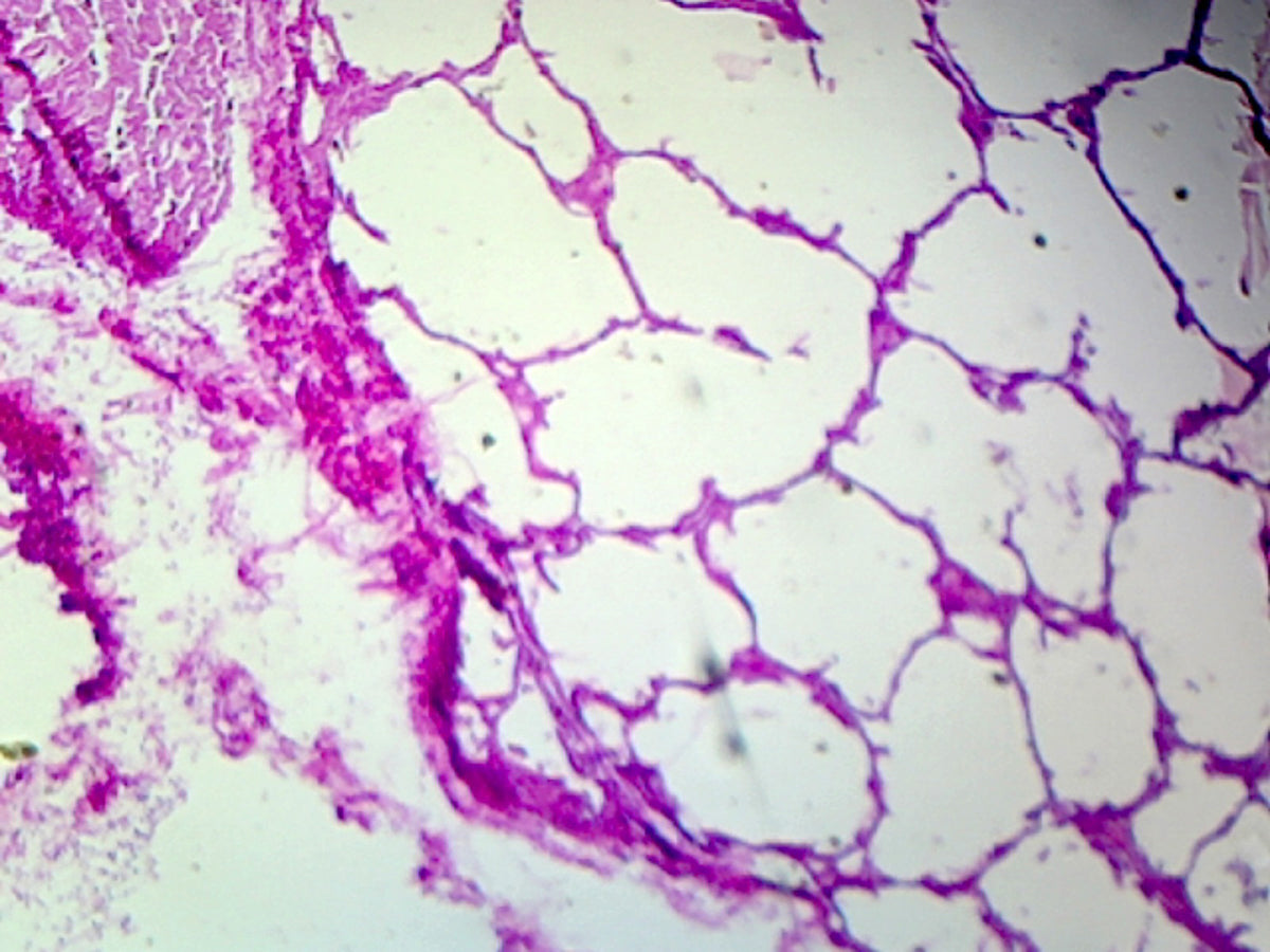 Microscope Slide, Lung of a Smoker, Human; Showing Alveoli; Section